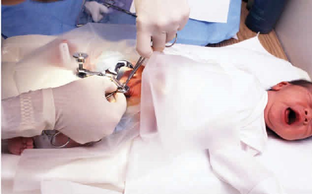 عمل جراحی ختنه مردان